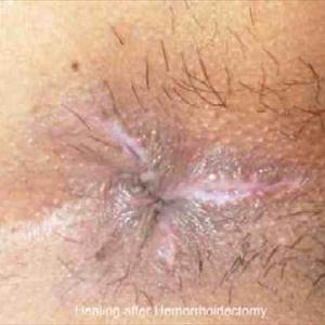 Pretruding Hemeroid - Hemorrhoids During Pregnancy - What You Need To Know