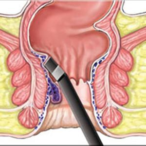 Hemorrhoids Operation - How To Avoid Hemorrhoids
