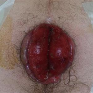 Do Hemorroids Hurt - Hemorrhoid Relief-How A Person Cure Hemorrhoid Successfully