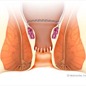 Enlarged Hemorrhoids - Symptoms Of Hemorrhoid Problems