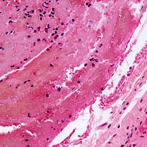 Blood In St - A Cure For Your Hemorrhoids