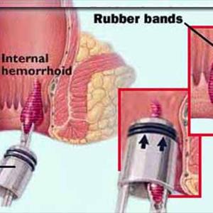 Honey Cures Hemmoriods - Tips For Making Troublesome Hemorrhoids Less Painful