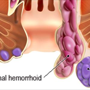 Stress And Hemroids - Home Remedies On How To Stop Bleeding Hemorrhoids