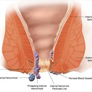Calmovil Hemorrhoids Remedy - What You Need To Know About External Hemorrhoids
