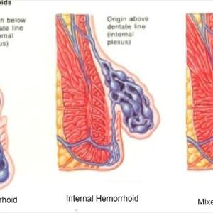 Hemiclear - Sitz Bath For Dealing With Slight Cases Of Hemorrhoids