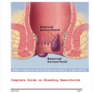 Hesperidin And Hemmorhoids - A Cure For Your Hemorrhoids
