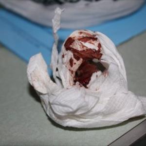 Hemmroid Surgery - Get Rid Of Hemorrhoids Fast And Painlessly - Identify Your Hemorrhoids