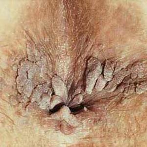 Is Hemorrhoids Contagious - Best Otc Hemorrhoid Treatment