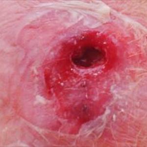 Hemorhoid Pillow - The Effective Procedure To Endure External Hemorrhoids
